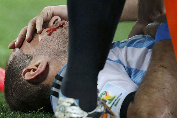  پس از برخورد پای "دیرک کویت" به صورت "پابلو زابالتا" بازیکن آرژانتین اینگونه مصدوم شد