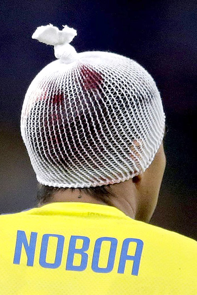  "کریستین نوبوآ" بازیکن کلمبیا دچار شکستگی از ناحیه سر شد