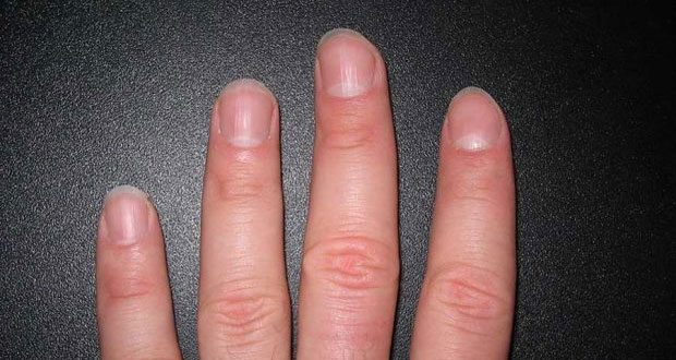 لکه های سفید ناخن با هلالی روی ناخن چه علائم و تفاوتی دارند ؟ 3 لکه های سفید ناخن