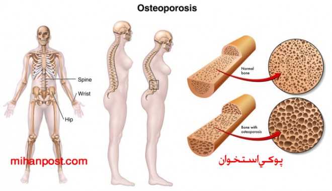 آن چه باید در مورد پوکی استخوان بدانیم + عکس 2 پوکی استخوان