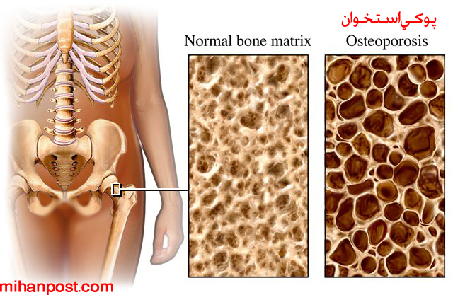 آن چه باید در مورد پوکی استخوان بدانیم + عکس 7 osteoporosis4