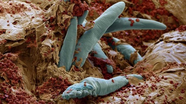 Demodex folliculorum (3)