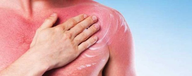 عوارض آفتاب سوختگی را با تغذیه کنترل کنید ؟ 4 درمان آفتاب سوختگی