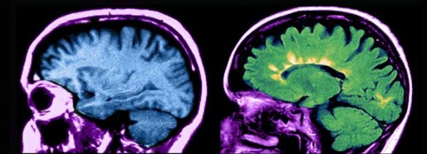 درمان بیماری ام اس