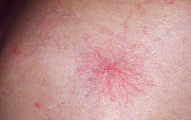 علائمی که نشان دهنده بیماری های کبدی است ؟ 10 علائم و نشان های بیماری کبدی