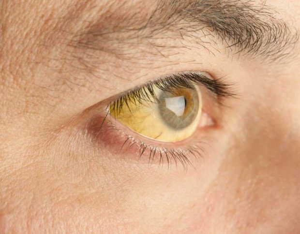 علائمی که نشان دهنده بیماری های کبدی است ؟ 8 علائم و نشان های بیماری کبدی