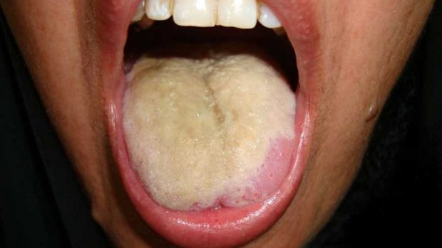 علائمی که نشان دهنده بیماری های کبدی است ؟ 2 علائم و نشان های بیماری کبدی