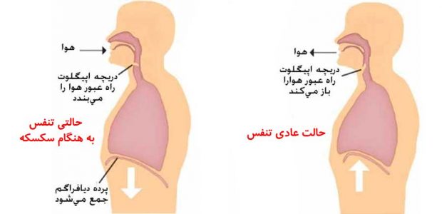سکسکه و آن چه را که باید درباره علت و درمانش بدانیم ؟ 4 سکسکه