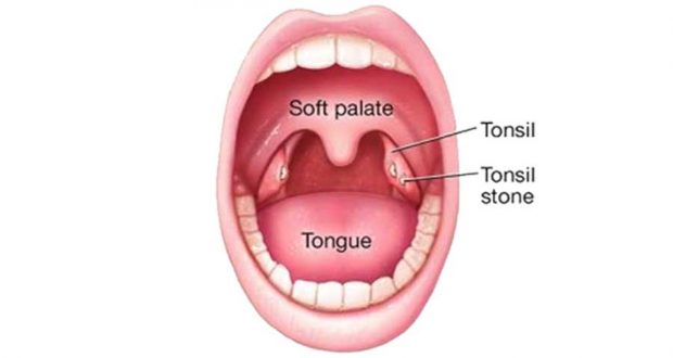 سنگ لوزه یا تجمع خوش خیم باکتری ها در گلو را جدی بگیرید 2 سنگ لوزه