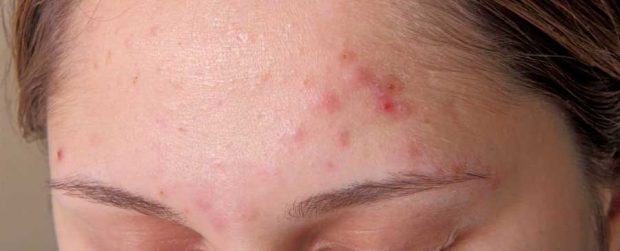 آکنه سلول های پوست مبتلایان را جوان و مقاوم نگاه می دارد ! 2 آکنه سلول های پوست مبتلایان را جوان و مقاوم نگاه می دارد