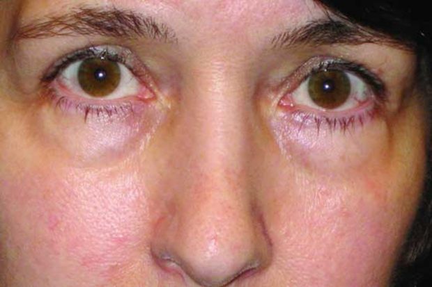 عوارض بوتاکس