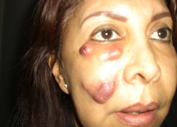 عوارض بوتاکس