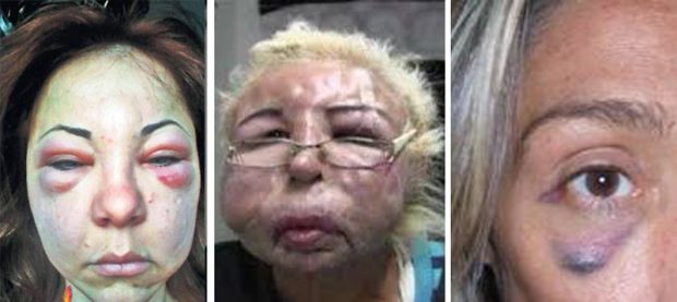 عوارض بوتاکس