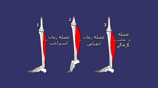 گرفتگی عضلات