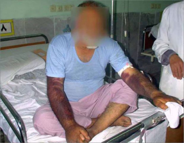 علائم تب کنگو را به همراه روش های پیشگیری از آن بشناسید 2 علائم تب کنگو