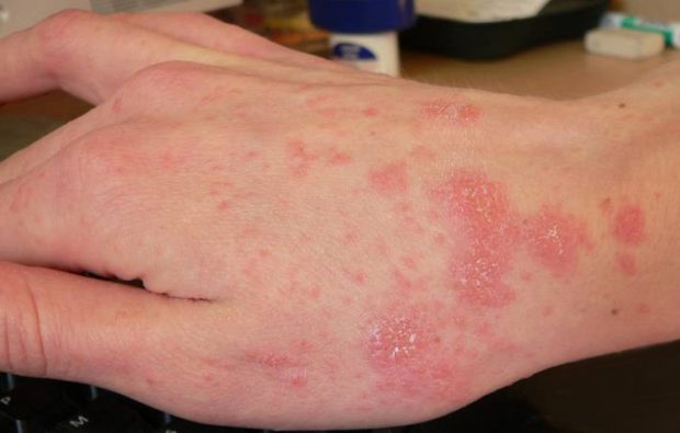 بیماری گال چیست و راهکارهای درمان آن چگونه است ؟ 4 بیماری گال