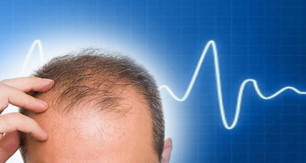 Hair loss heart attack 1