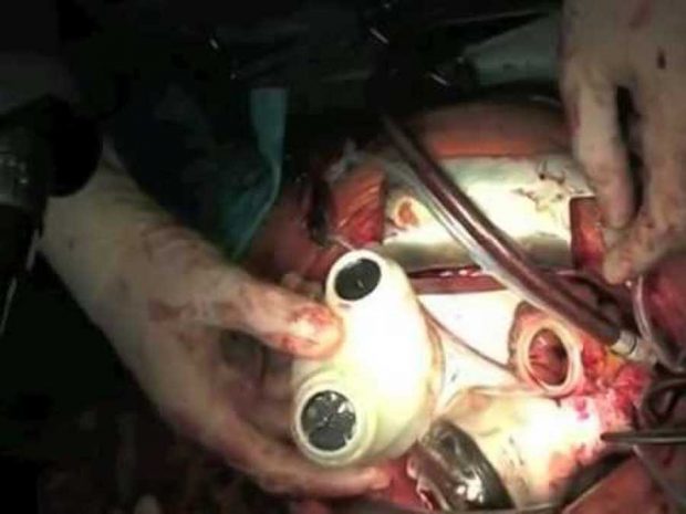 قلبش مصنوعی