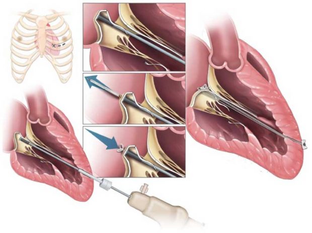 جراحی دریچه میترال بدون عمل قلب باز