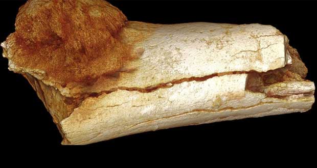 کشف علائم سرطان در استخوان‌ 1/7 میلیون ساله انسان