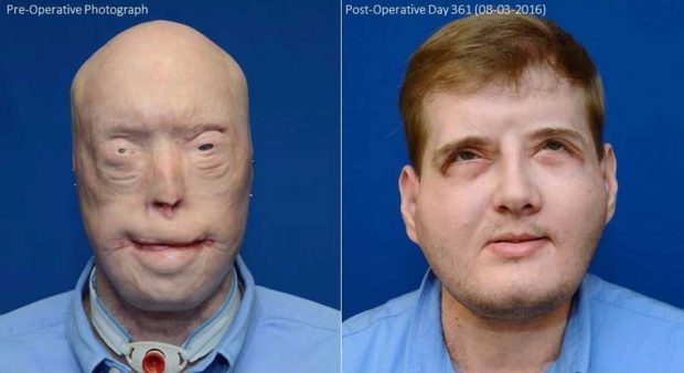 پیوند صورت هاردیسون آتش نشان بعد از یکسال