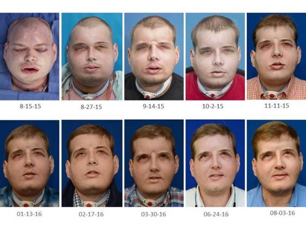 پیوند صورت هاردیسون آتش نشان بعد از یکسال