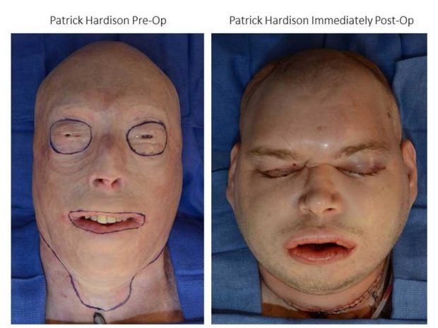 پیوند صورت هاردیسون آتش نشان بعد از یکسال