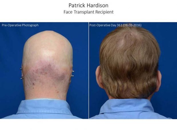 پیوند صورت هاردیسون آتش نشان بعد از یکسال