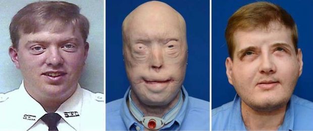 پیوند صورت هاردیسون آتش نشان بعد از یکسال