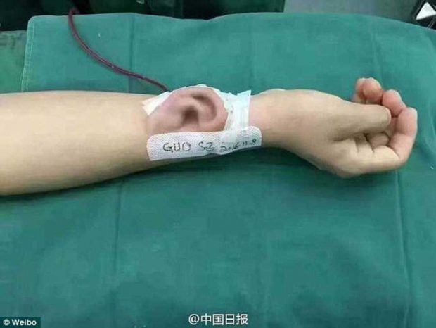 جراحی پلاستیک عجیب برای پرورش گوش روی ساعد