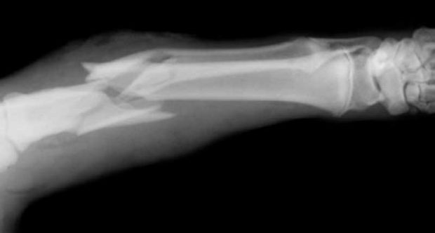درمان شکستگی استخوان با روشی جالب و سریع توسط محققان + عکس 2 درمان شکستگی استخوان.