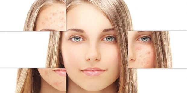 برطرف کردن لکه های پوستی با ترفندهایی ساده و کارآمد ؟ 2 برطرف کردن لکه های پوستی