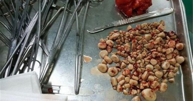درمان خانگی سنگ کلیه