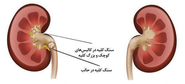 درمان خانگی سنگ کلیه