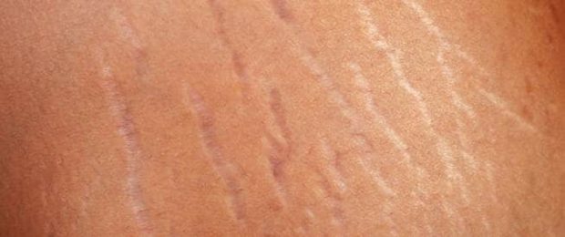 رفع پارگی پوست