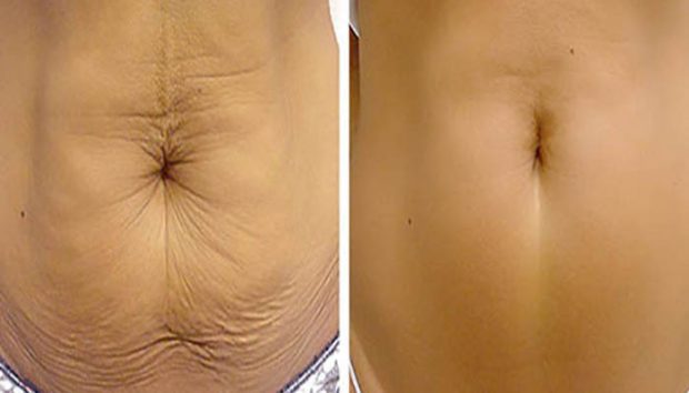 راهکارهایی برای درمان افتادگی پوست بعد از زایمان ؟ 4 درمان افتادگی پوست بعد از زایمان