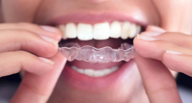 نگاهی به روش جدید ارتودنسی نامرئی دندان یا ارتودنسی ژله ای 3 ارتودنسی نامرئی دندان یا ارتودنسی ژله ای