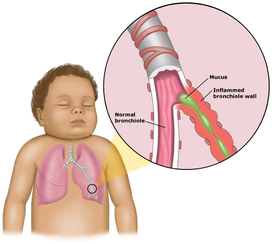 ویروس سین‌ سیشیال تنفسی Respiratory Syncytial Virus