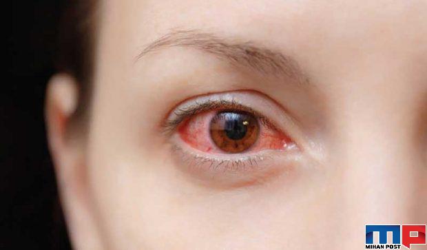 تبخال زدن چه دلایلی دارد و چگونه میتوان از آن جلوگیری کرد ؟ 3 تبخال زدن