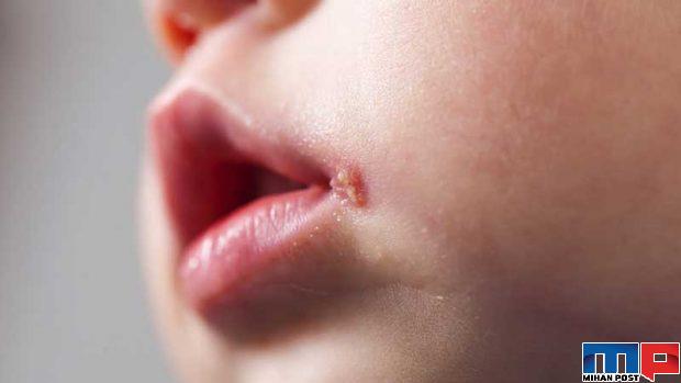 تبخال زدن چه دلایلی دارد و چگونه میتوان از آن جلوگیری کرد ؟ 2 تبخال زدن