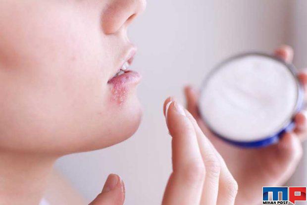 تبخال زدن چه دلایلی دارد و چگونه میتوان از آن جلوگیری کرد ؟ 4 تبخال زدن