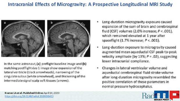 افزایش حجم مغز فضانوردان