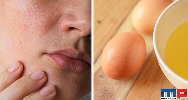 بستن منافذ پوست با راهکارهایی طبیعی و خانگی 1 بستن منافذ پوست