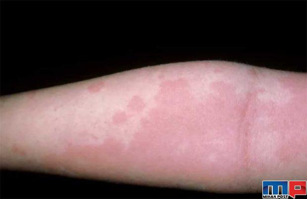 جدیدترین نشانه های کرونا