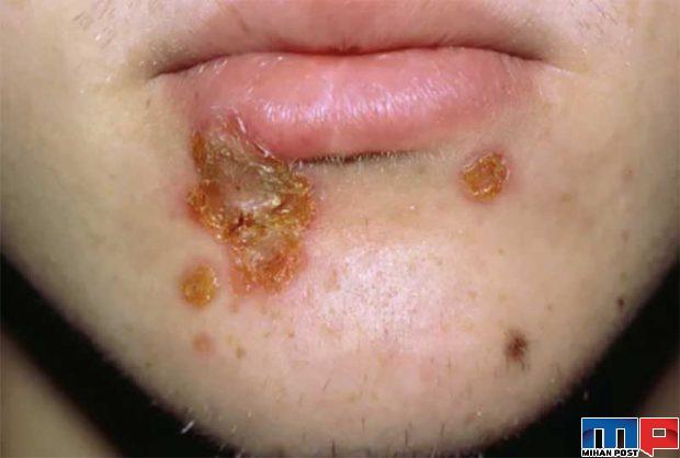 جدیدترین نشانه های کرونا