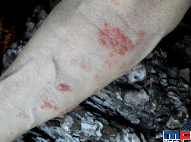 جدیدترین نشانه های کرونا