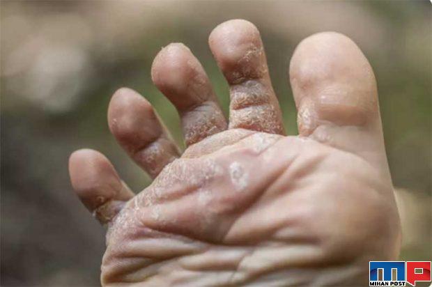 جدیدترین نشانه های کرونا