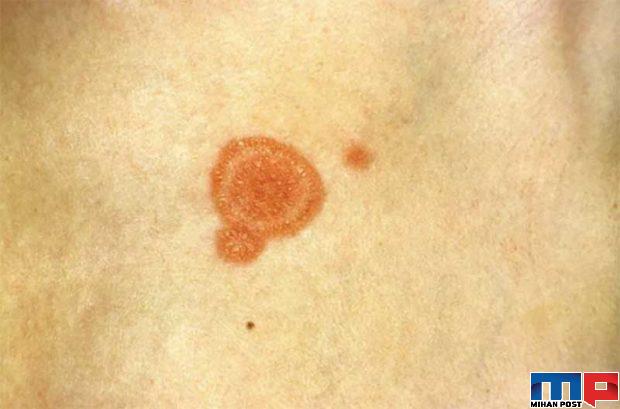 جدیدترین نشانه های کرونا