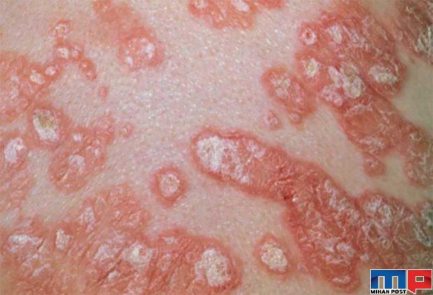 جدیدترین نشانه های کرونا