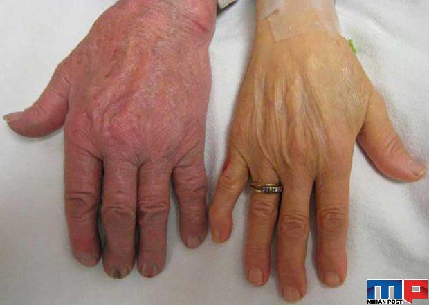 بیماری آدیسون چه آسیب هایی به بدن می رساند ؟ 3 بیماری آدیسون